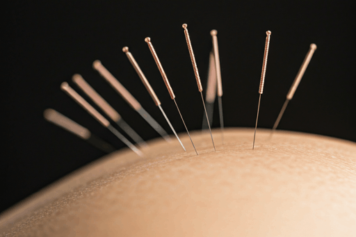 Acupuntura